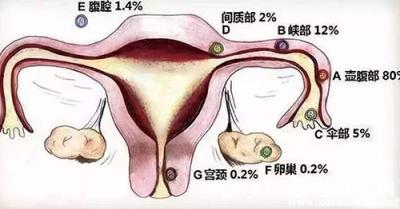 盆腔炎會腰疼嗎 女性盆腔炎有哪些癥狀