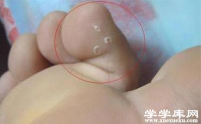 怎樣治腳氣 治療腳氣的最佳方法