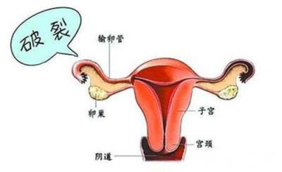 宮外孕會來月經嗎 宮外孕怎么辦