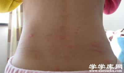 成人水痘傳染嗎 水痘的癥狀圖片