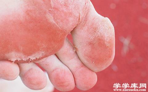 腳上長水泡很癢怎么辦 腳上長水泡的注意事項