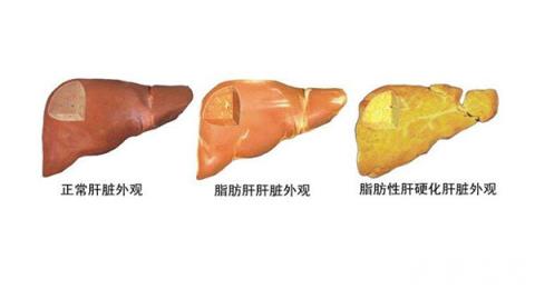 脂肪肝不能吃什么 脂肪肝患者的飲食禁忌